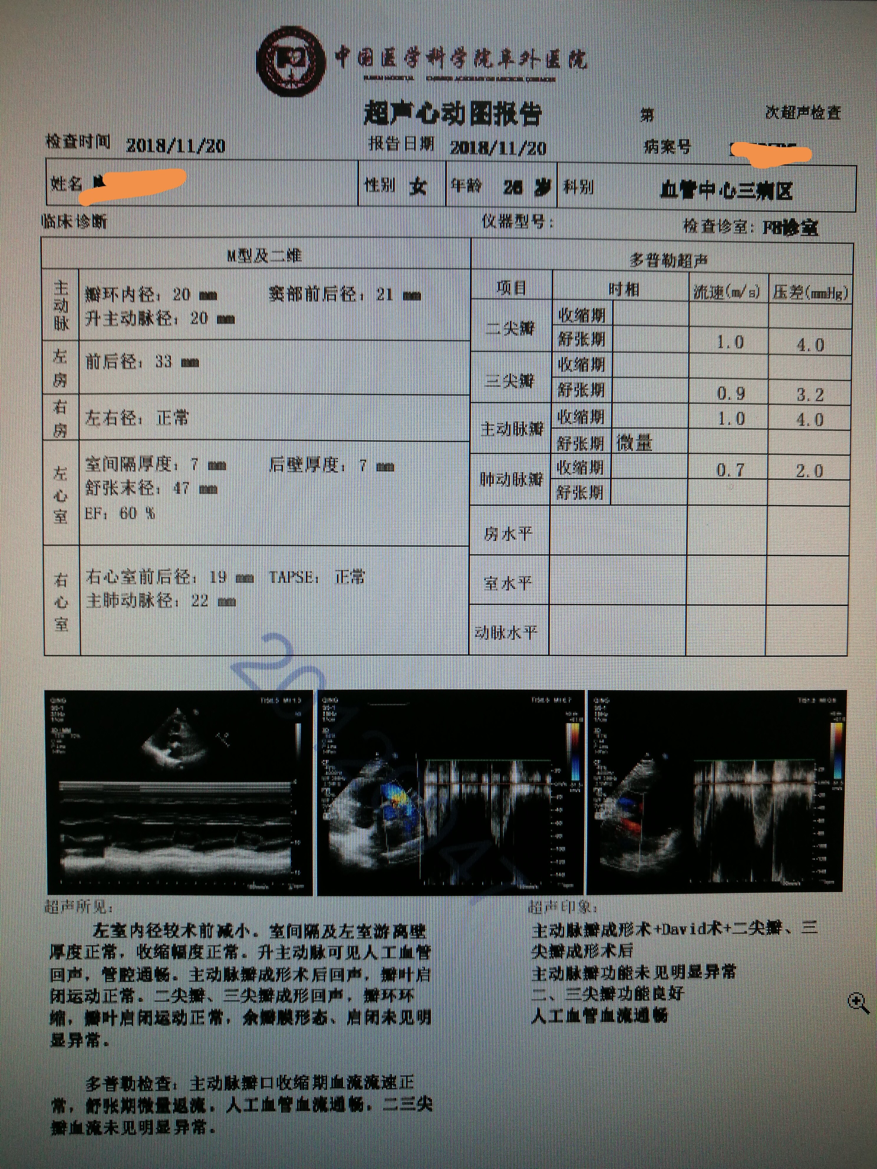 马凡氏综合症合并主动脉关闭不全二尖瓣关闭不全