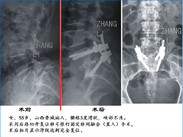 重度峡部不连性腰椎滑脱疑难病例5例病人图