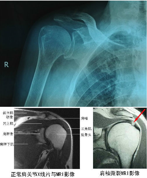 肩袖损伤与肩周炎