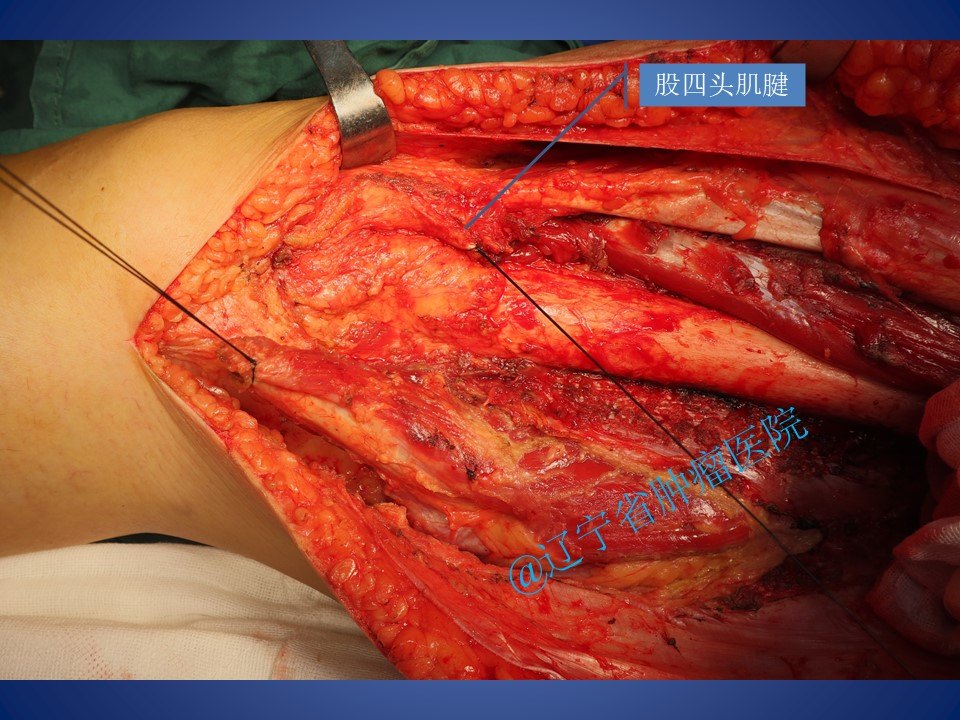 股部前侧肌群软组织肉瘤手术病例