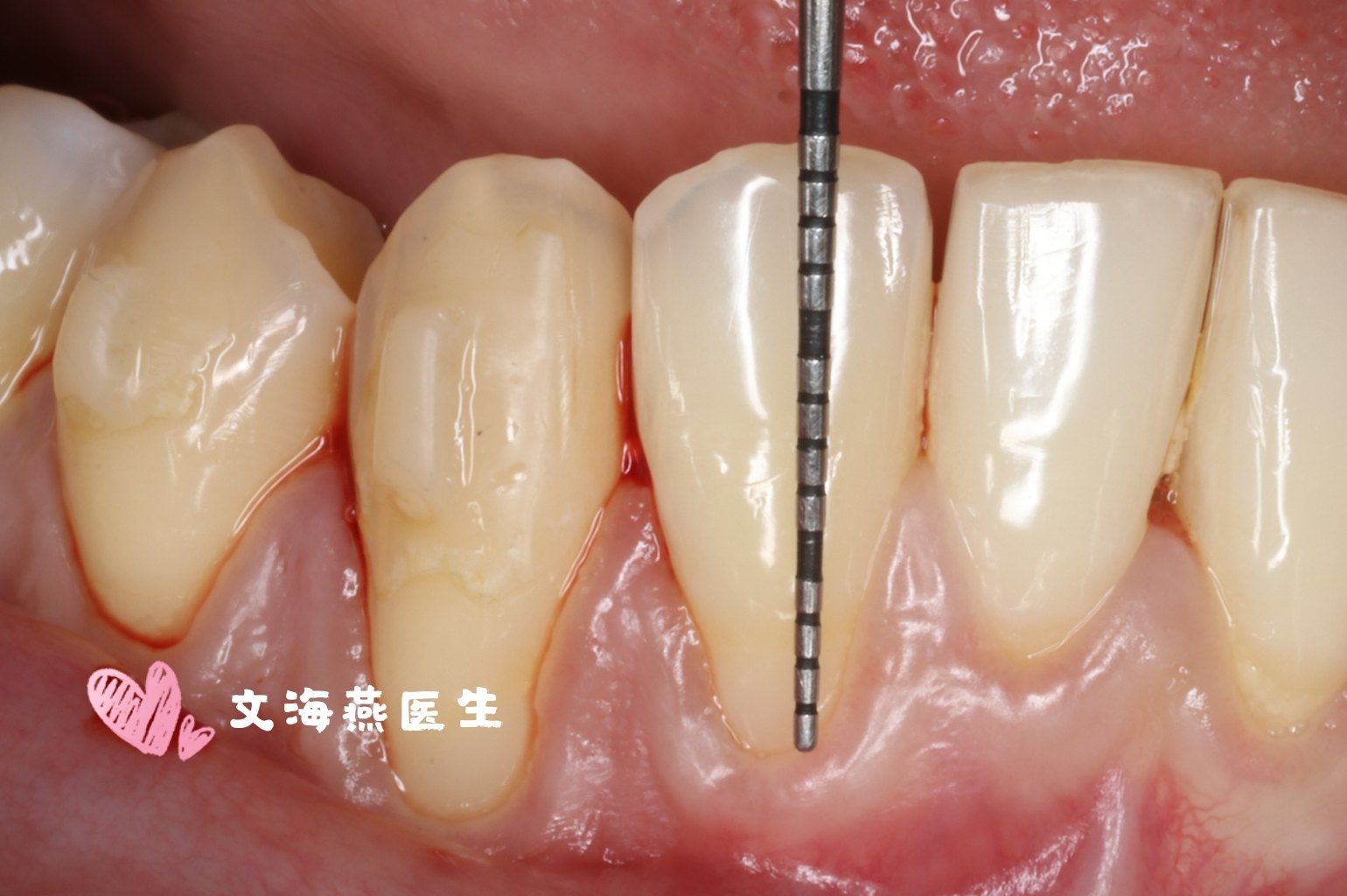 牙龈退缩治疗案例_牙龈萎缩 - 好大夫在线