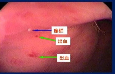 什么是萎缩性胃炎?