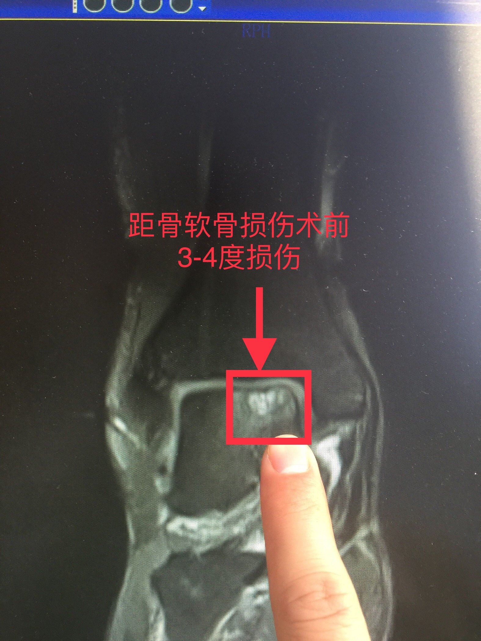 踝关节扭伤三月后出现距骨坏死!真可惜!