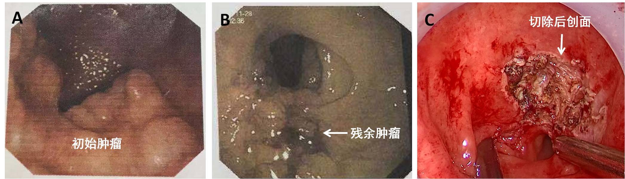 大片直肠肿瘤经肛巧切除