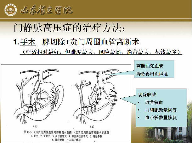 脾切除 贲门周围血管离断术