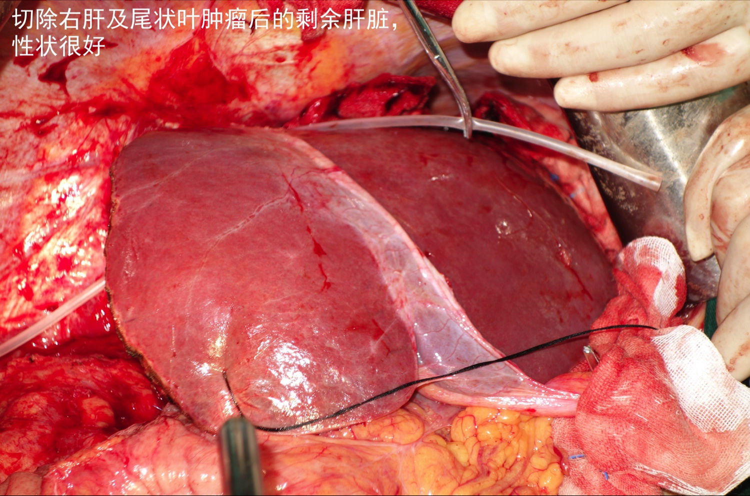 巨大尾状叶肝细胞肝癌切除术1例