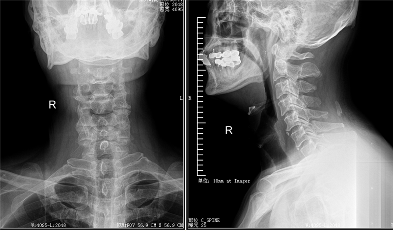 颈椎正侧位片