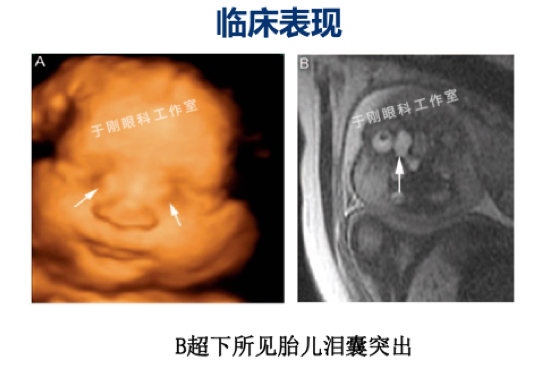 婴幼儿先天性泪囊突出治疗