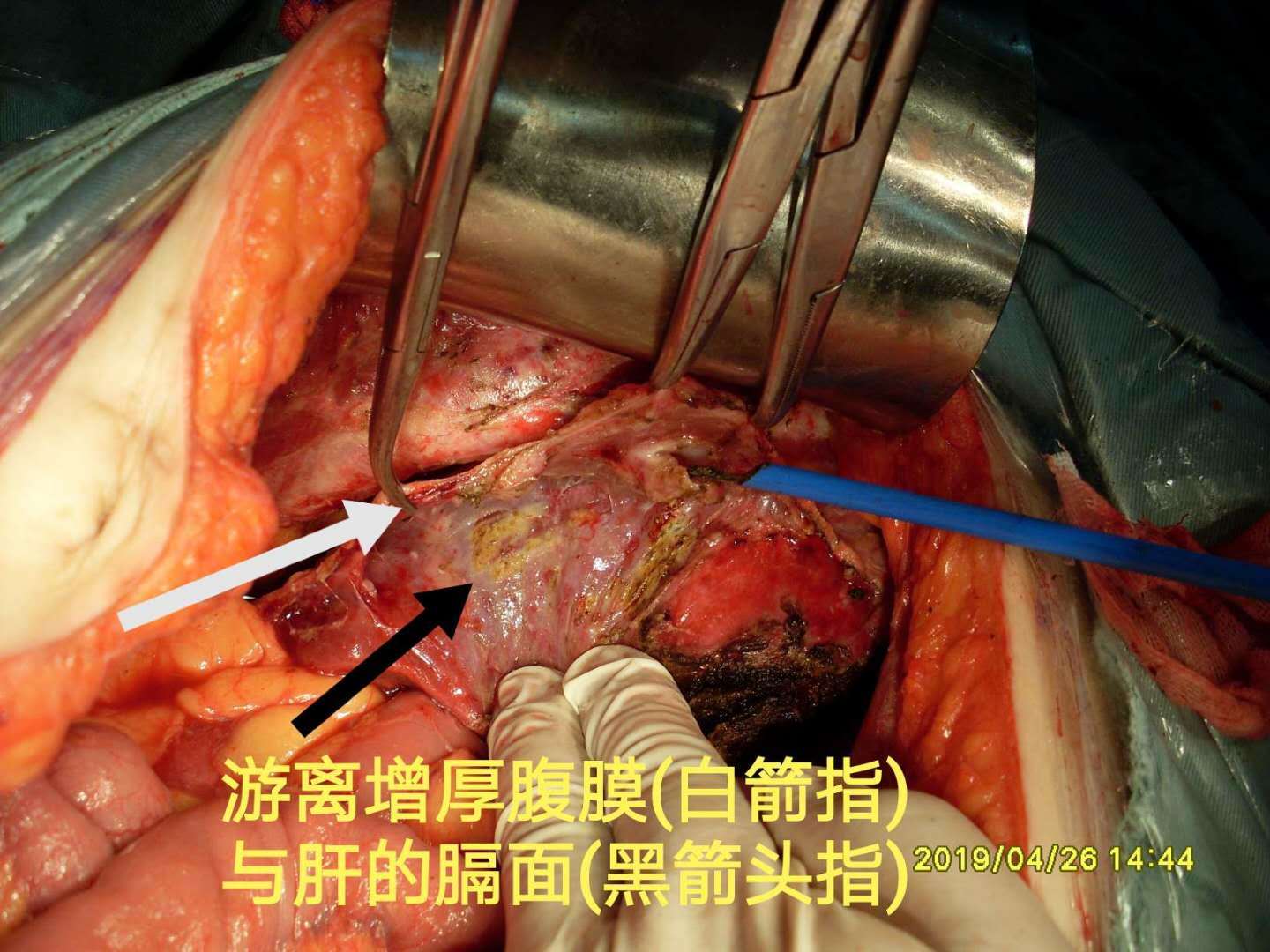 8 手术过程:淡黄色腹水,清亮,无粘液,量约1000mⅠ,送肿瘤标志物,脱落