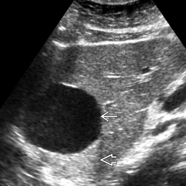 超声影像显示肝脏巨大囊肿,图中箭头所指黑色的囊肿