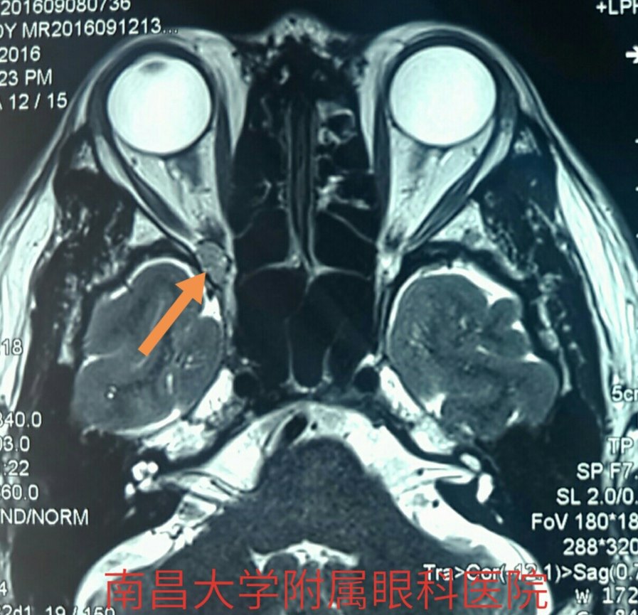 眶尖肿瘤导航内镜技术突破不可能