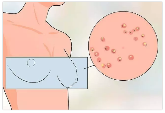 乳腺癌高发,如何早期发现?【健康大讲堂】
