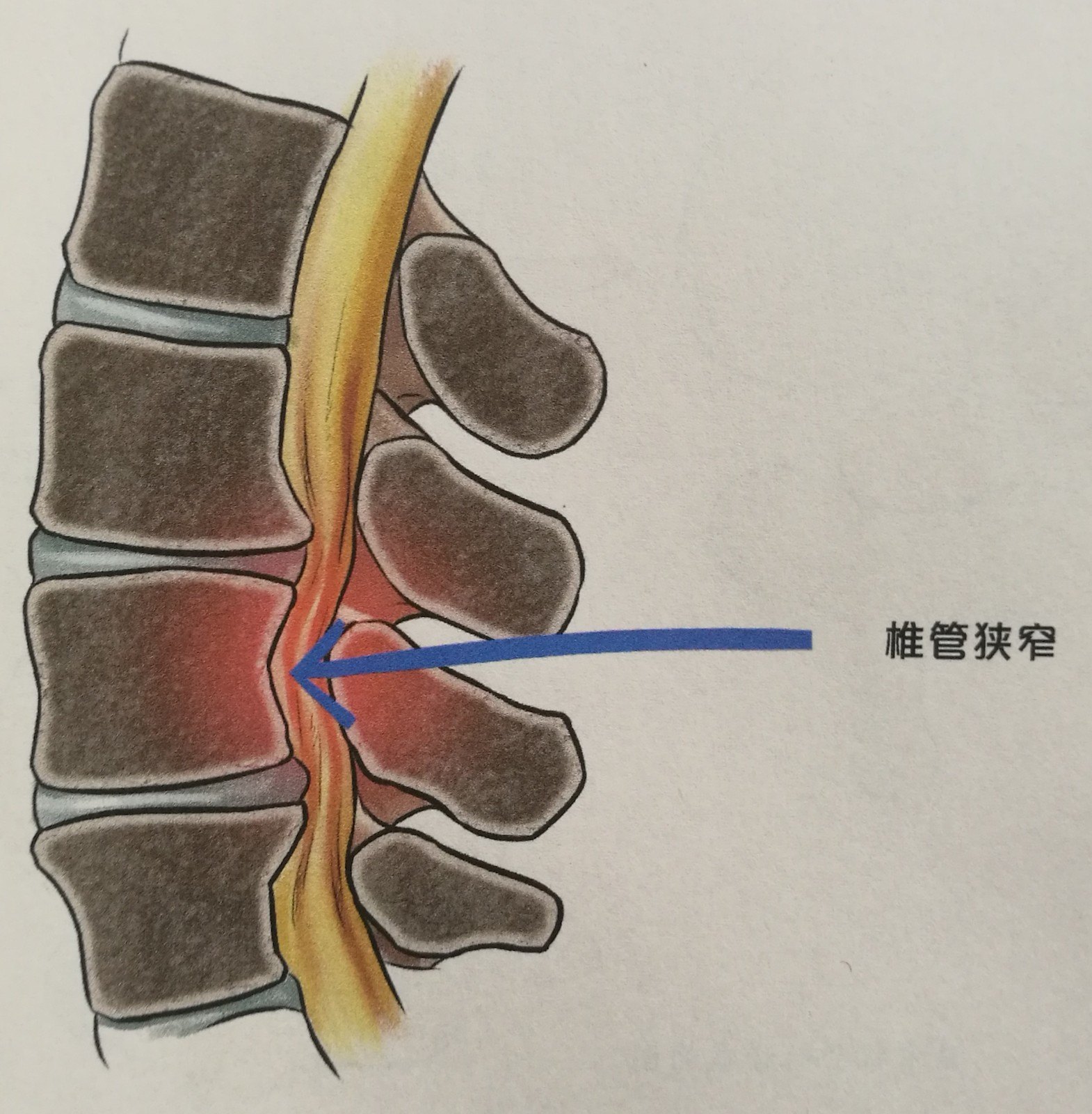 腰椎管狭窄症 (  lumbar spinal stenosis syndrome,简称: lsss )是