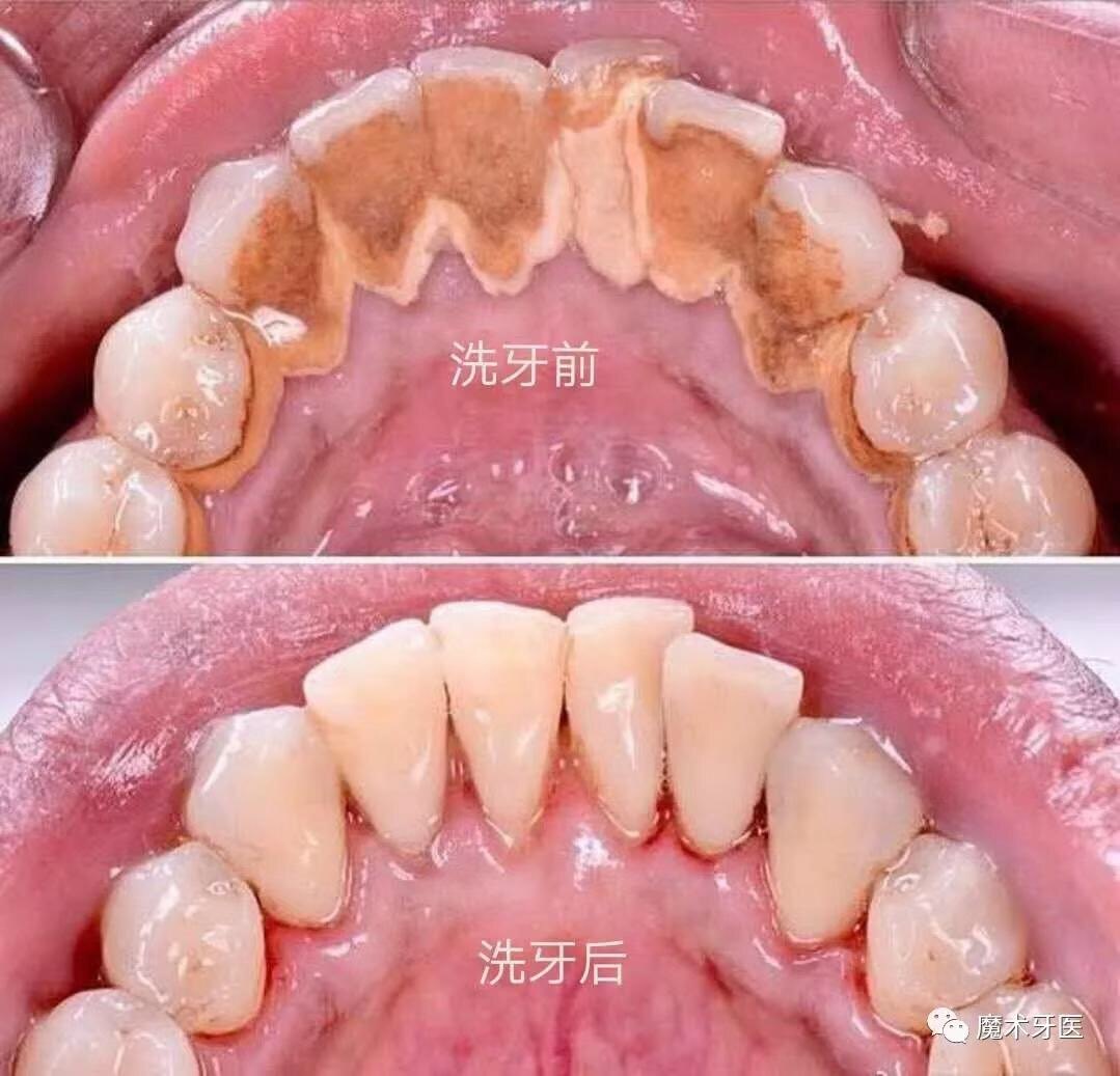 转载:牙周炎,中国成年人后半生永远的痛