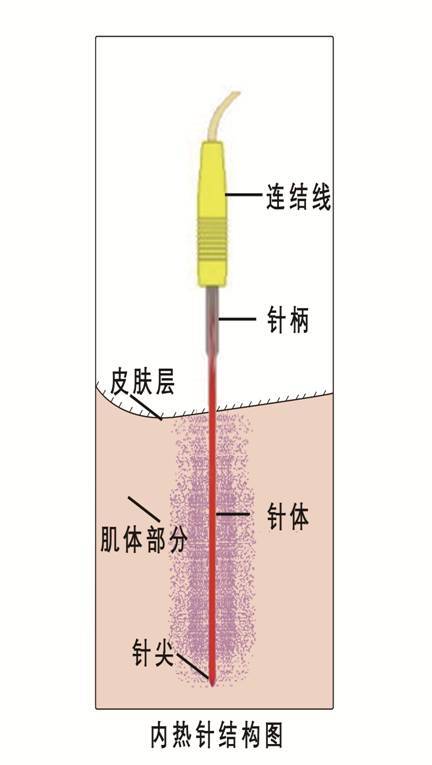 内热针治疗肱骨外上髁炎