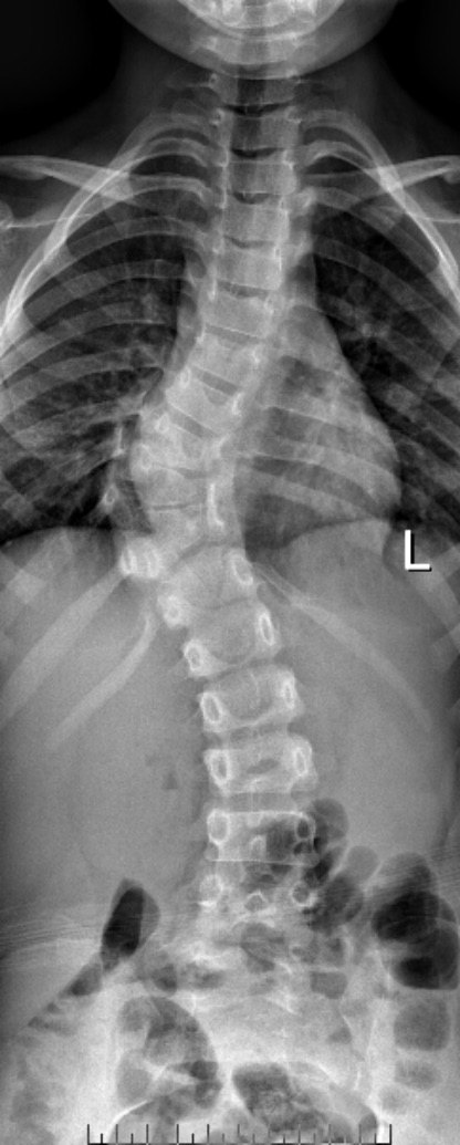 先天性脊柱侧弯病例