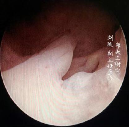 宫腔镜是诊断子宫内膜病变的利器,有必要进行诊刮明确内膜情况时