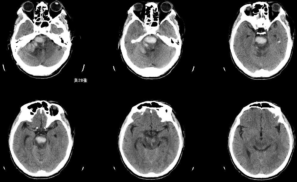 脑干出血的手术治疗立体定向下脑干出血血肿穿刺引流术是在 ct 计算