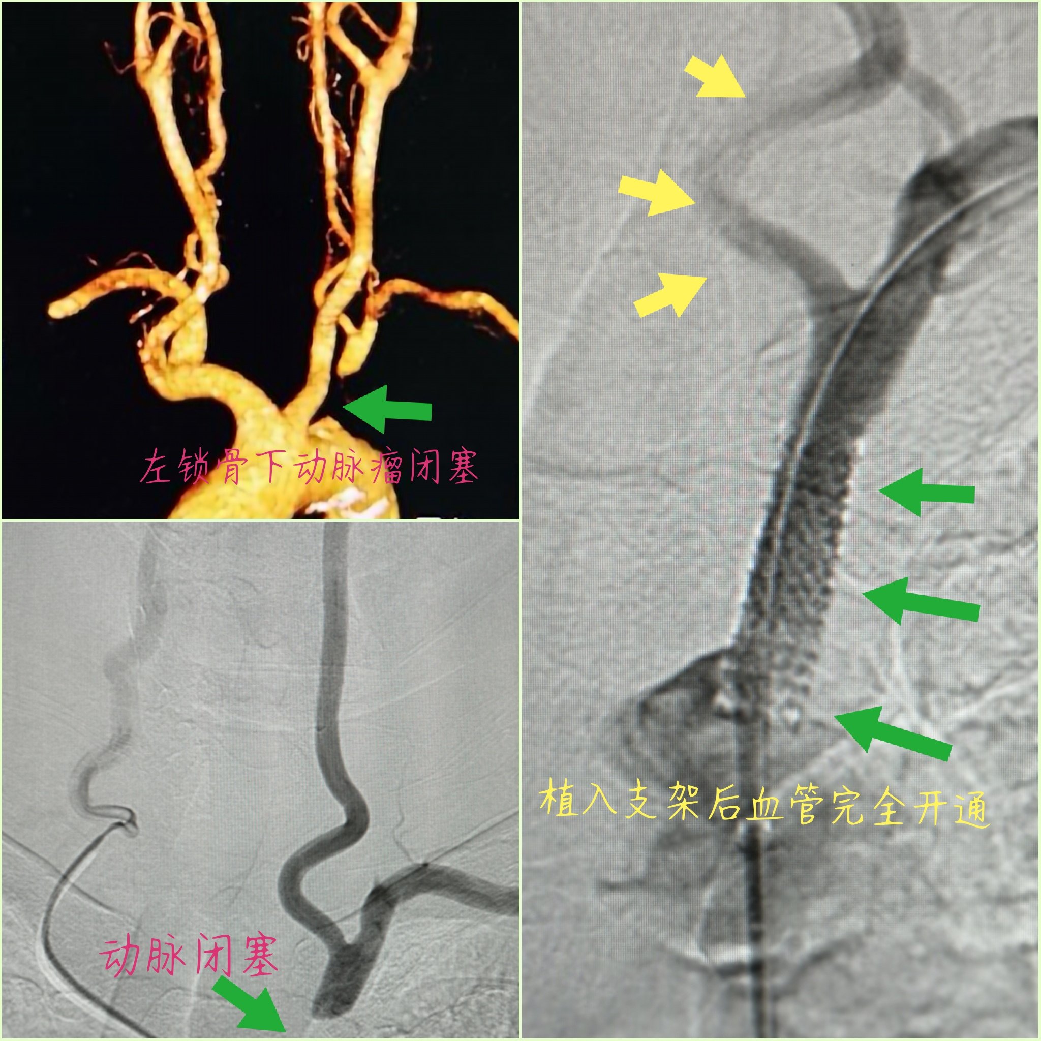 锁骨下动脉闭塞顺利开通|dr盖延廷病例精选