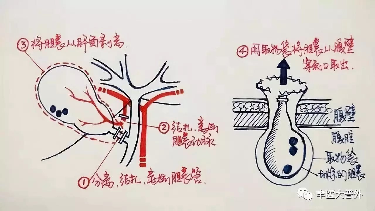 该方案腹腔镜下一期完成手术,一次有创操作能够较彻底完成治疗而不