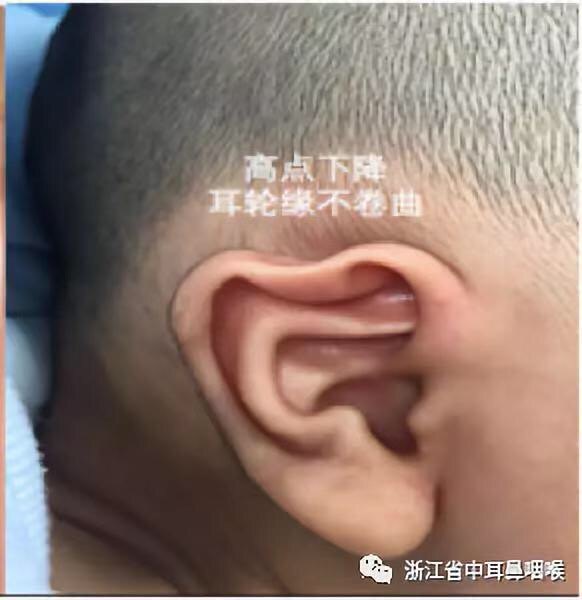 新生儿耳畸形无创矫正