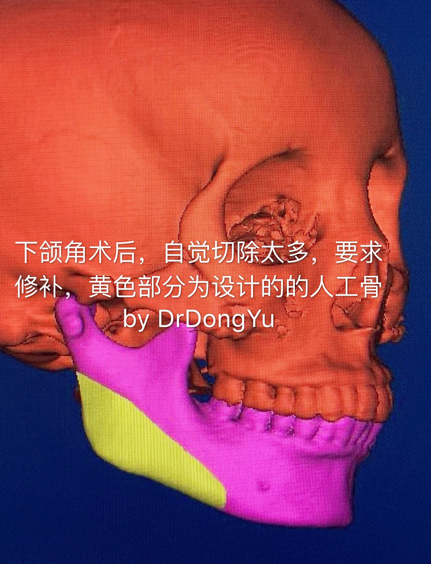 步骤:做ct—电脑上建模—电脑上设计人工骨—生产人工骨—手术植入