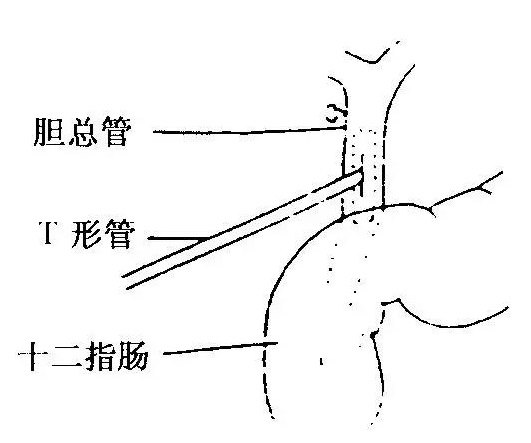 胆总管结石术后,带着"t管"回家怎么办?