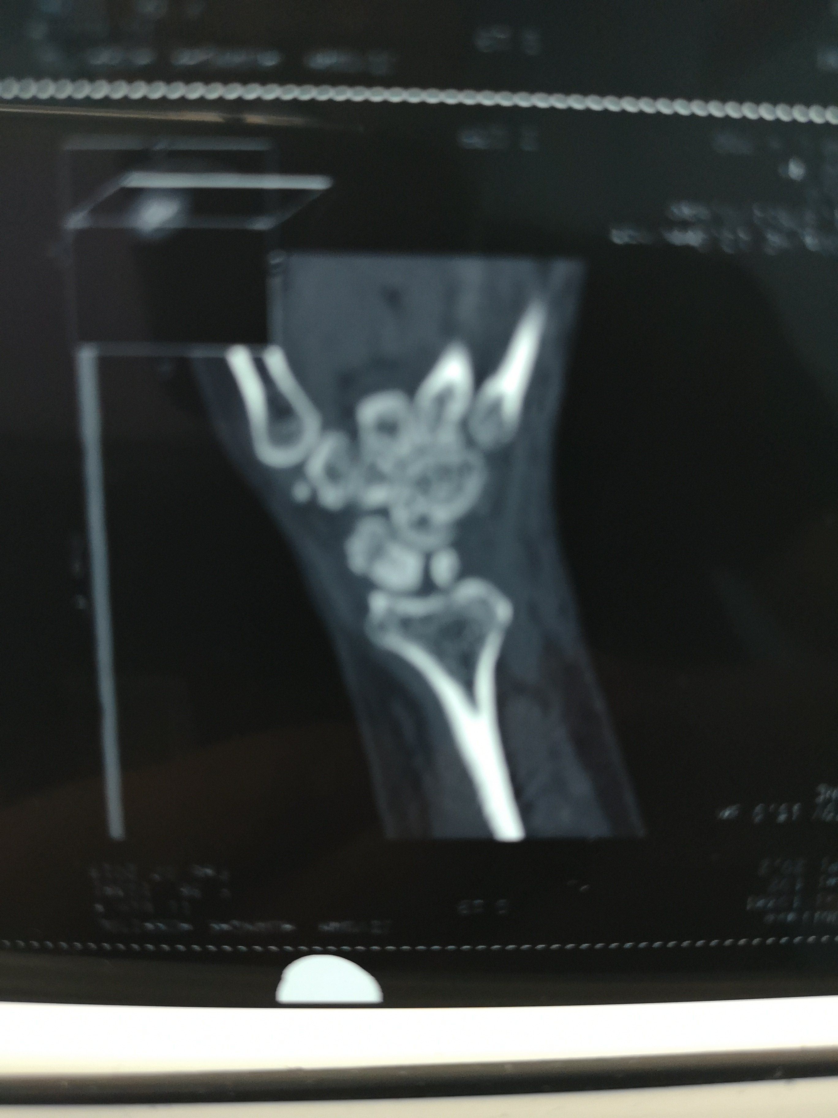 腕舟骨陈旧性骨折