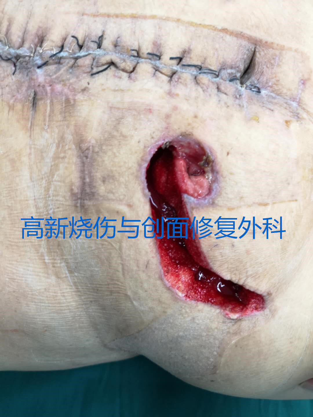 新技术治愈腹部结肠造瘘口巨大"人"字形复杂窦道