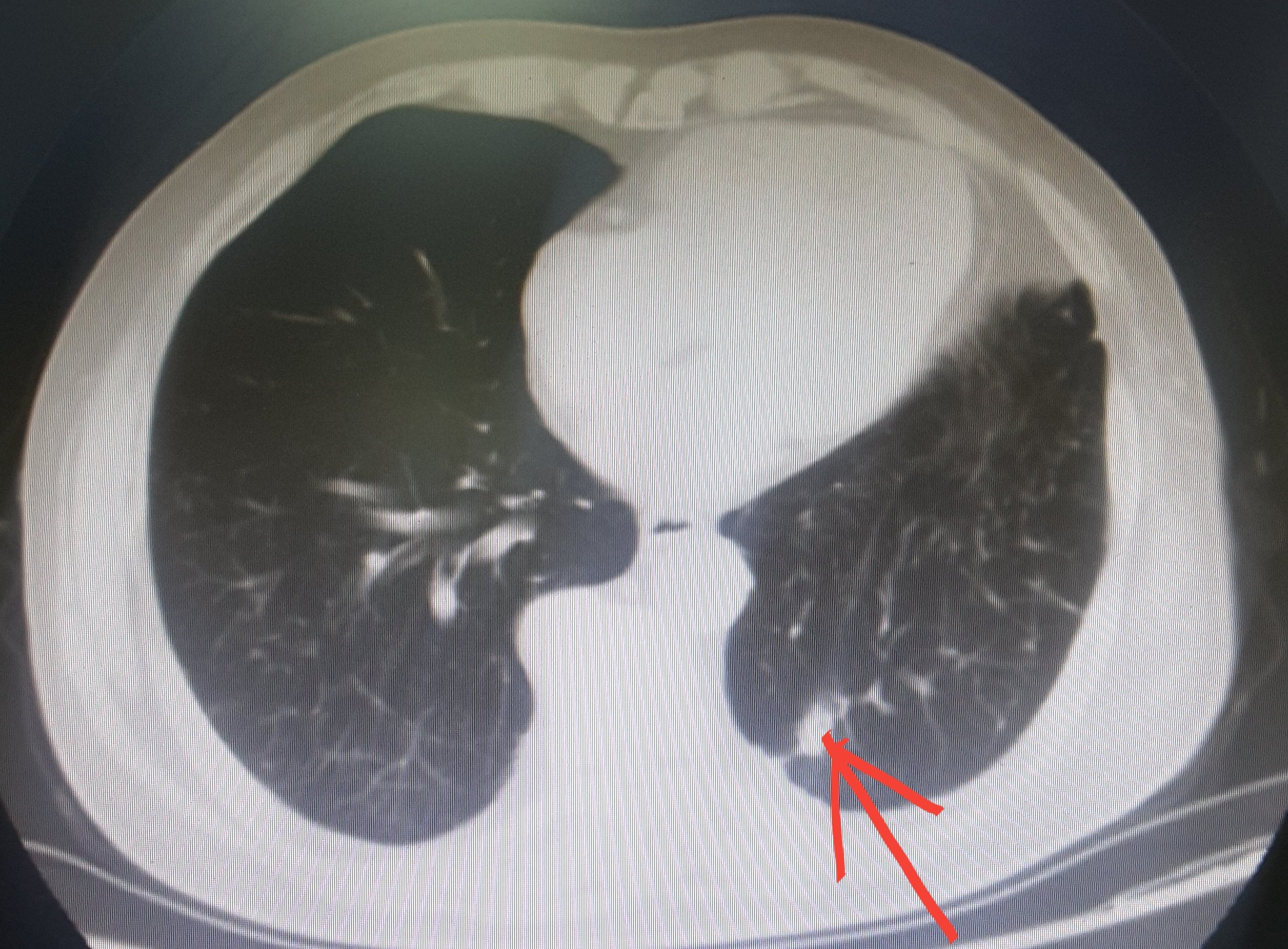 图15-10 经左肺上叶支气管的横断面-外科学-医学
