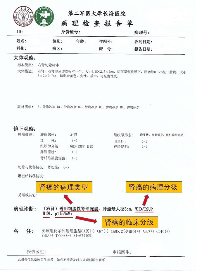 肾肿瘤问答之如何解读肾癌的病理报告