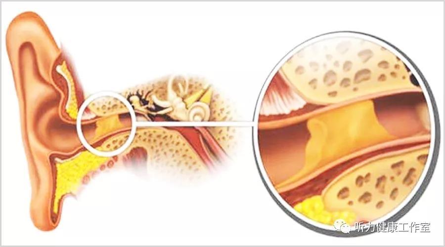 耳屎究竟要不要经常掏?_耵聍栓塞_预防_ - 好大夫在线