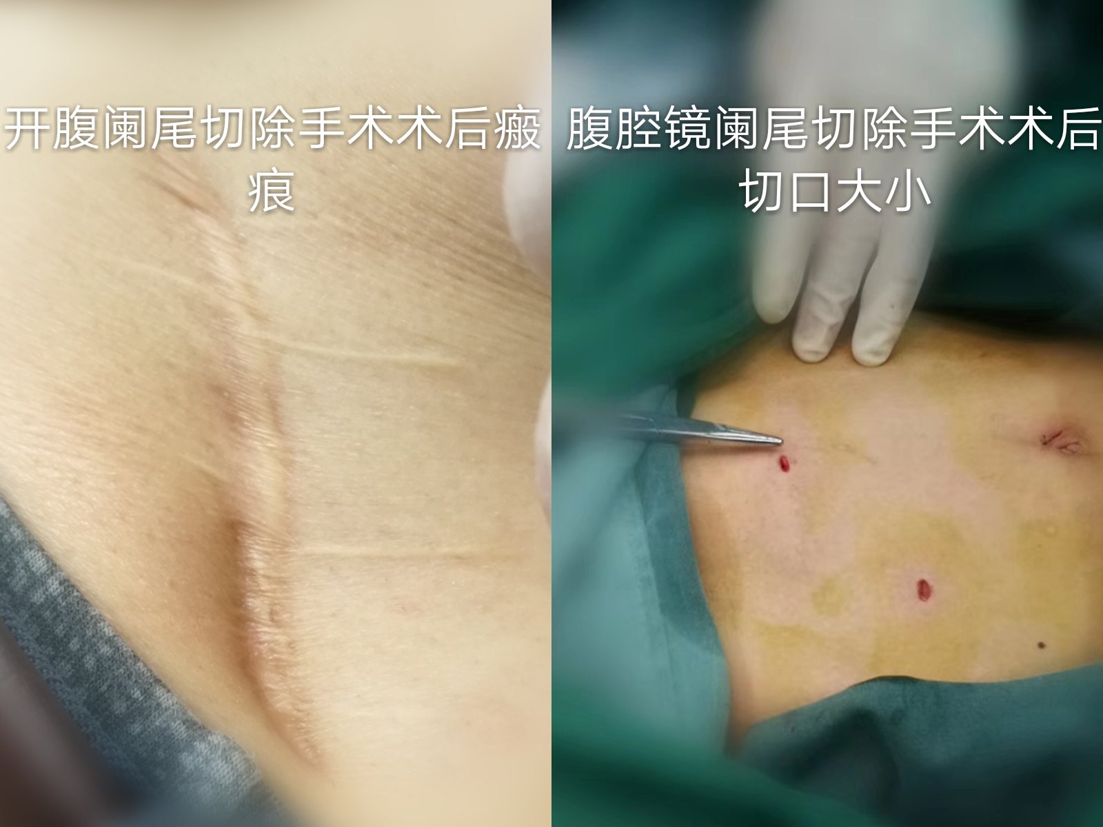 腹腔镜微创手术在阑尾炎治疗中的优势(有图有真相)