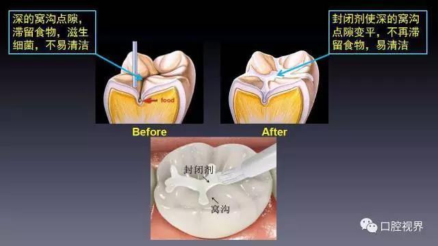 再加上这些牙的咬合面,颊面或舌面总是会有一些沟隙,这些窝沟点隙多且