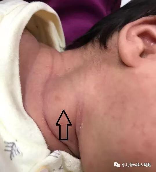 小婴儿头歪,一侧脖子可扪及无痛性包块家长警惕先天性肌性斜颈