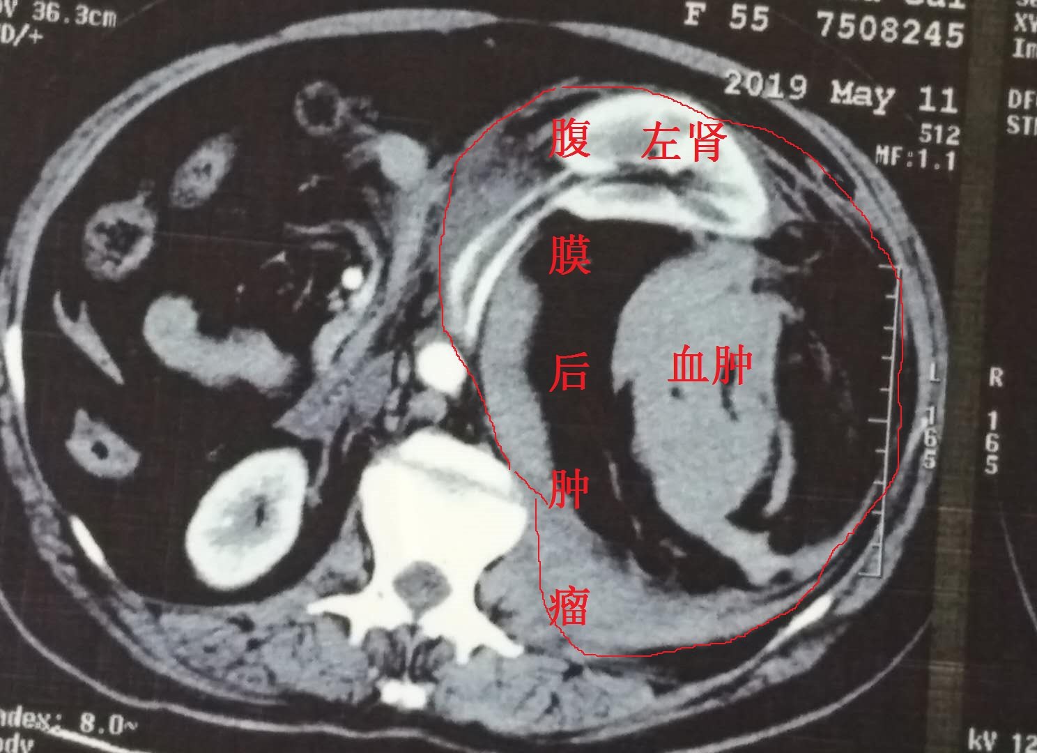 一例巨大腹膜后肿瘤合并自发性破裂大出血的患者获得成功救治