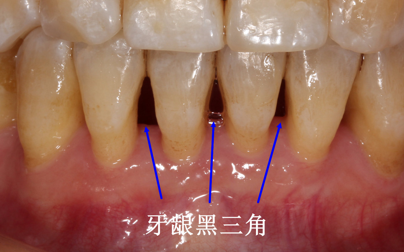 牙龈黑三角可以预防吗怎么消除