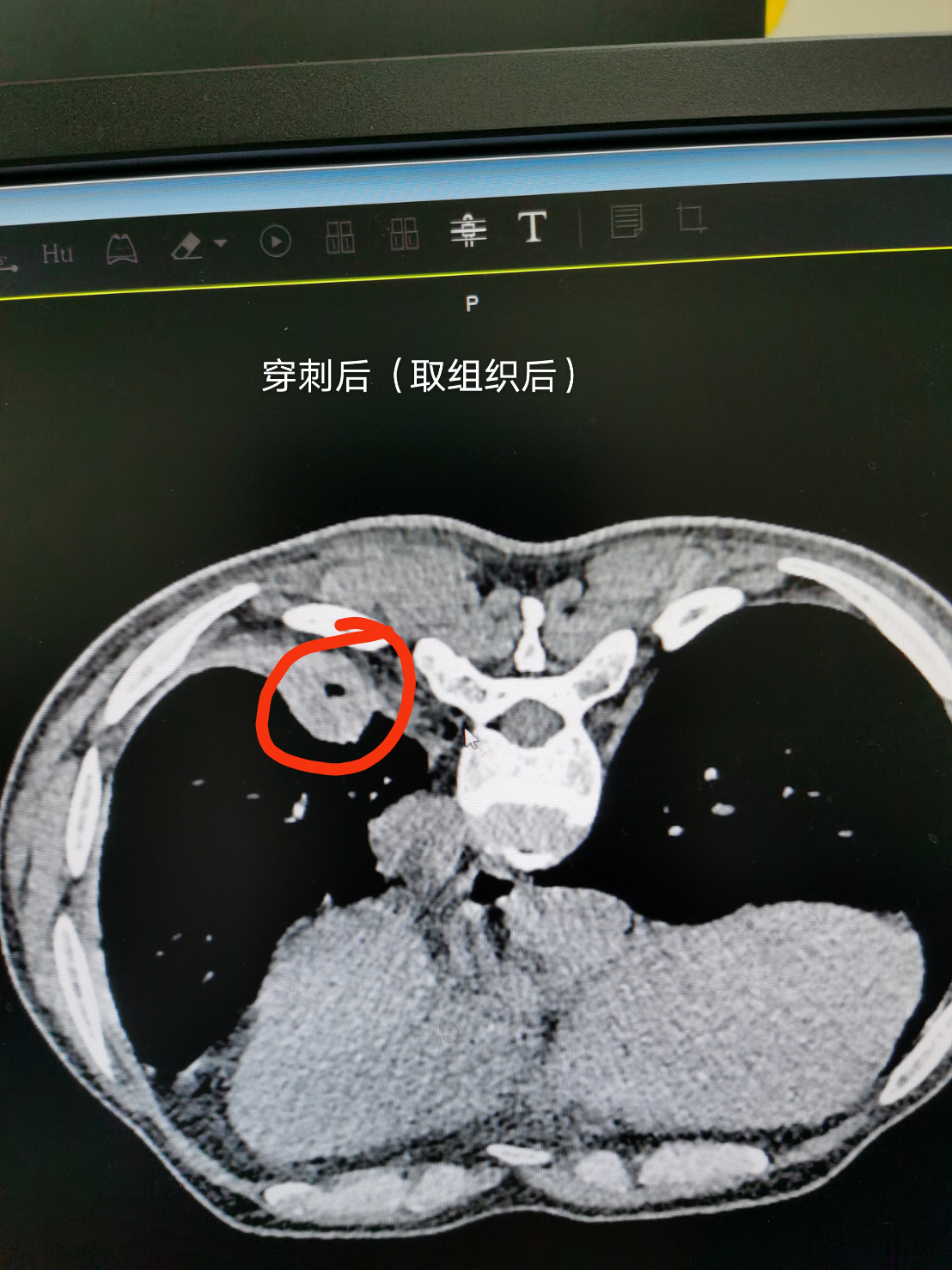 肺结节需要做肺穿刺吗
