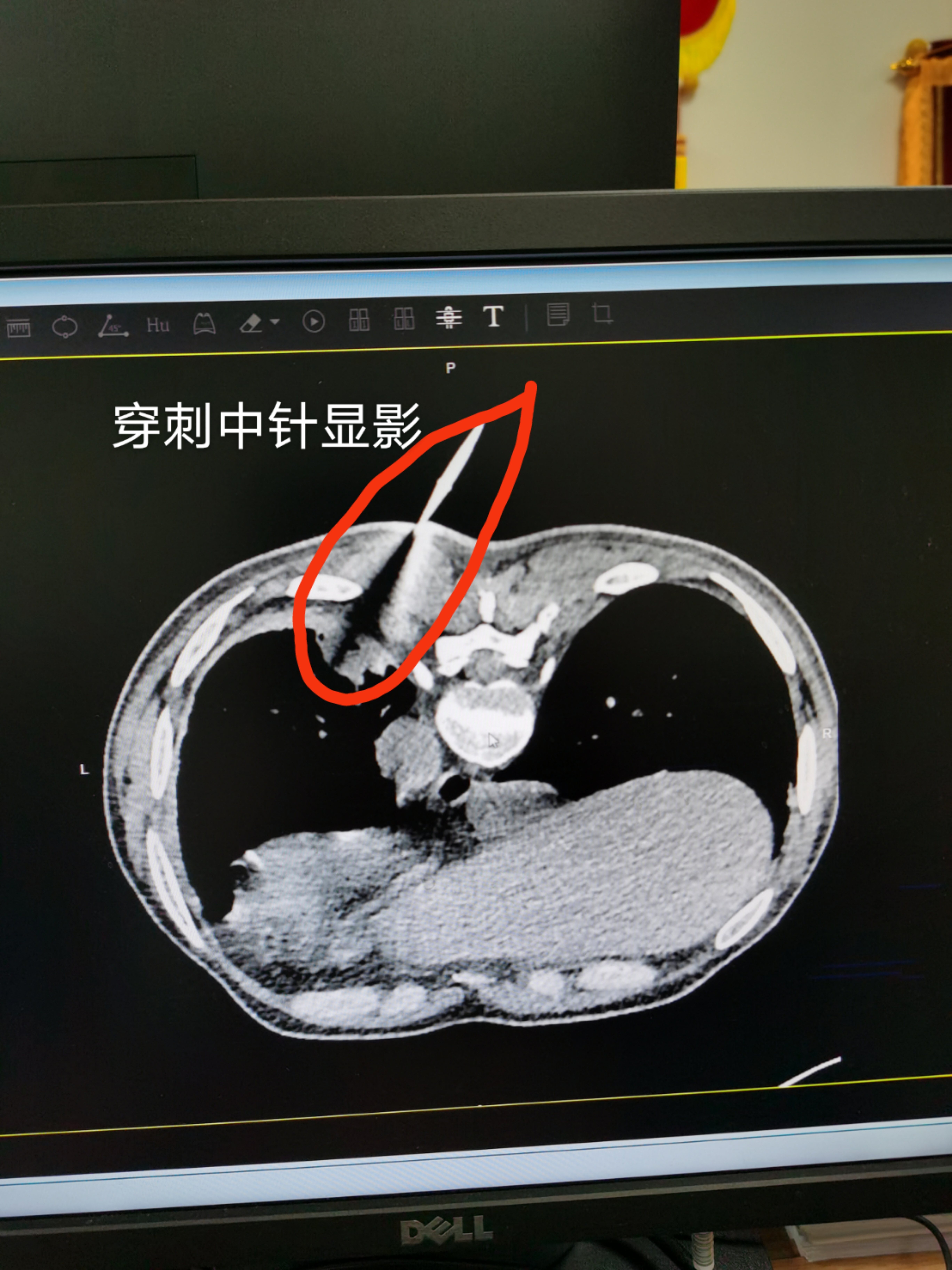 肺结节需要做肺穿刺吗