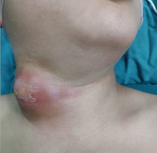 孩子颈部的包块预示着恶性肿瘤?别吓唬自己