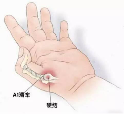 宝宝15个月大,最近发现俩手大拇指关节伸不直,该怎么办?