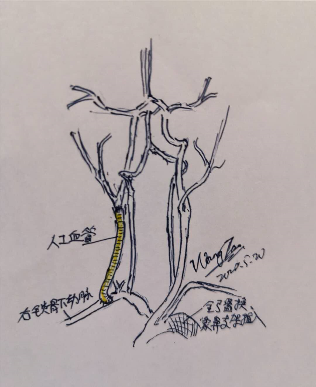 颈动脉-锁骨下动脉搭桥治疗高危颈总动脉闭塞