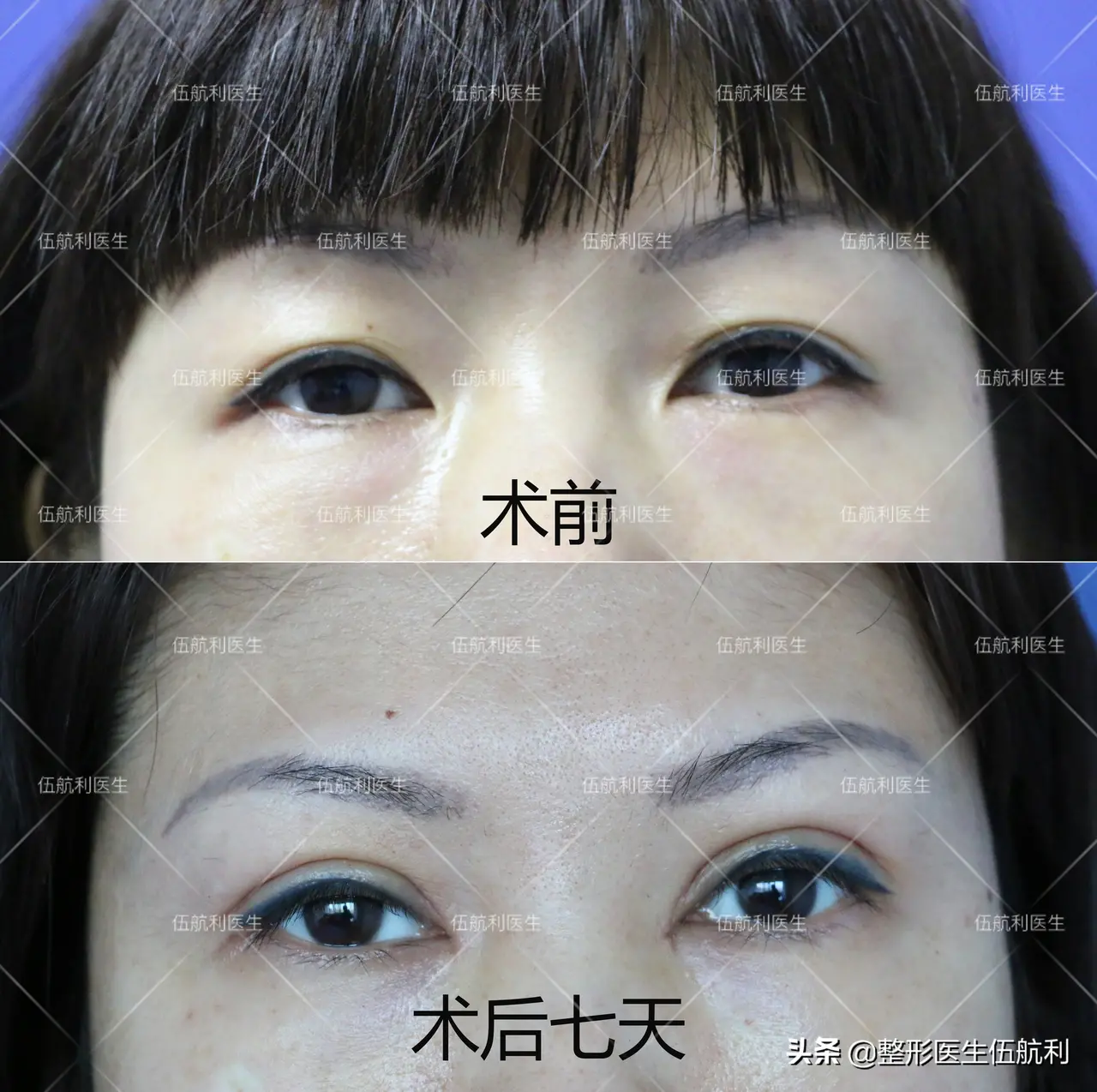 伍航利双眼皮案例分享:全切 开眼角术前术后七天对比