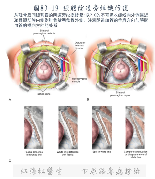 下尿路整合盆底13盆腔器官脱垂经阴和经腹重建手术介绍系列