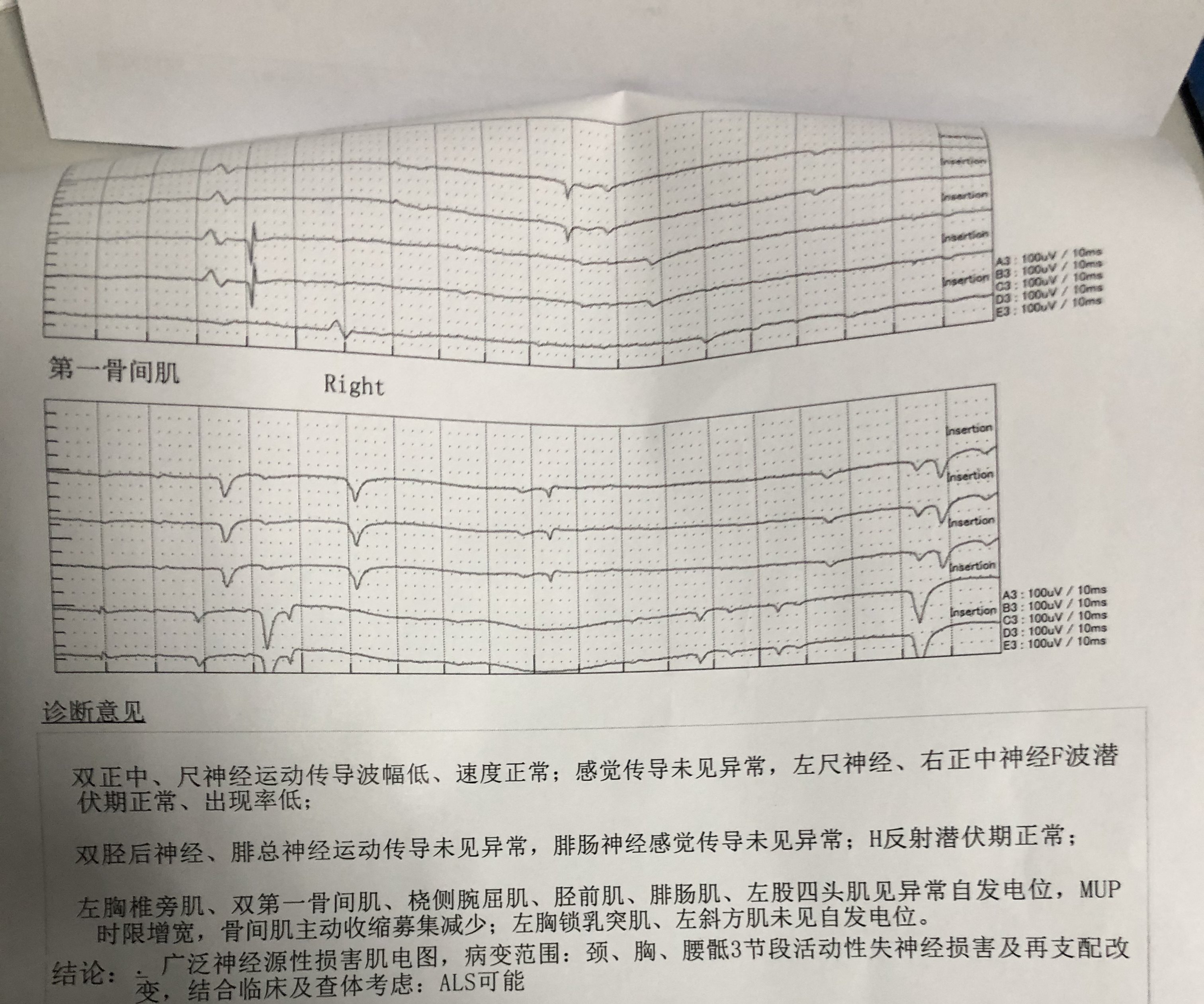 肌电图检测结果的报告(这个患者损害范围挺广泛的,初步怀疑als)