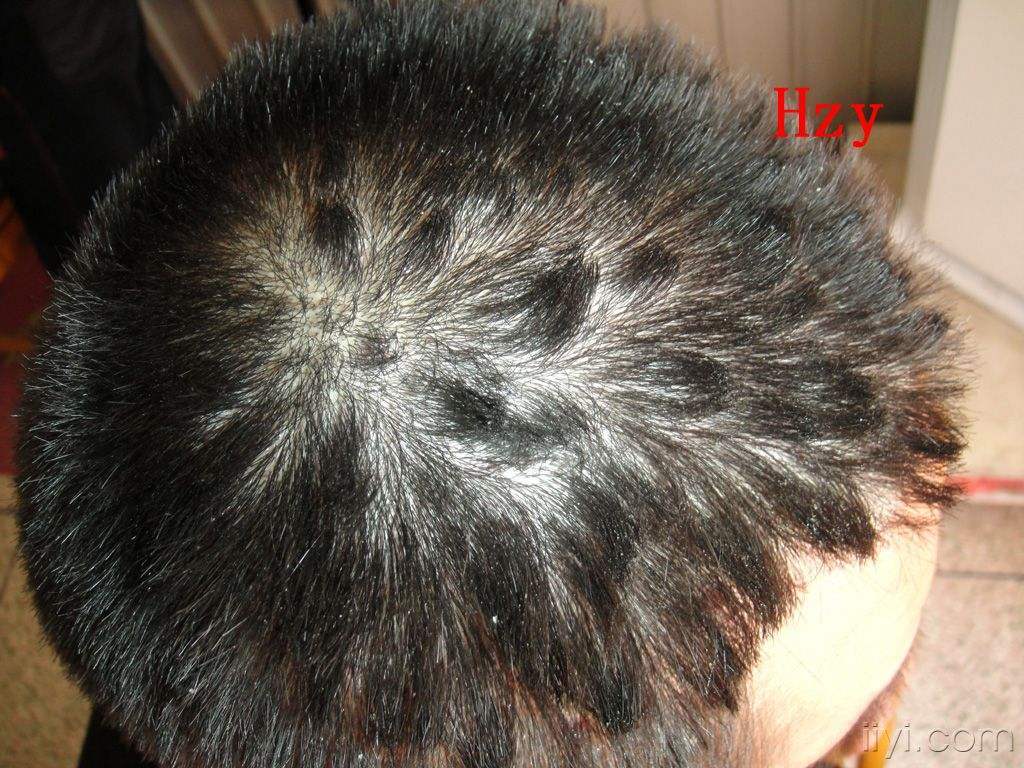 李中平 文章列表  典型的头皮银屑病皮损,头皮上有红斑,鳞屑,头发可呈