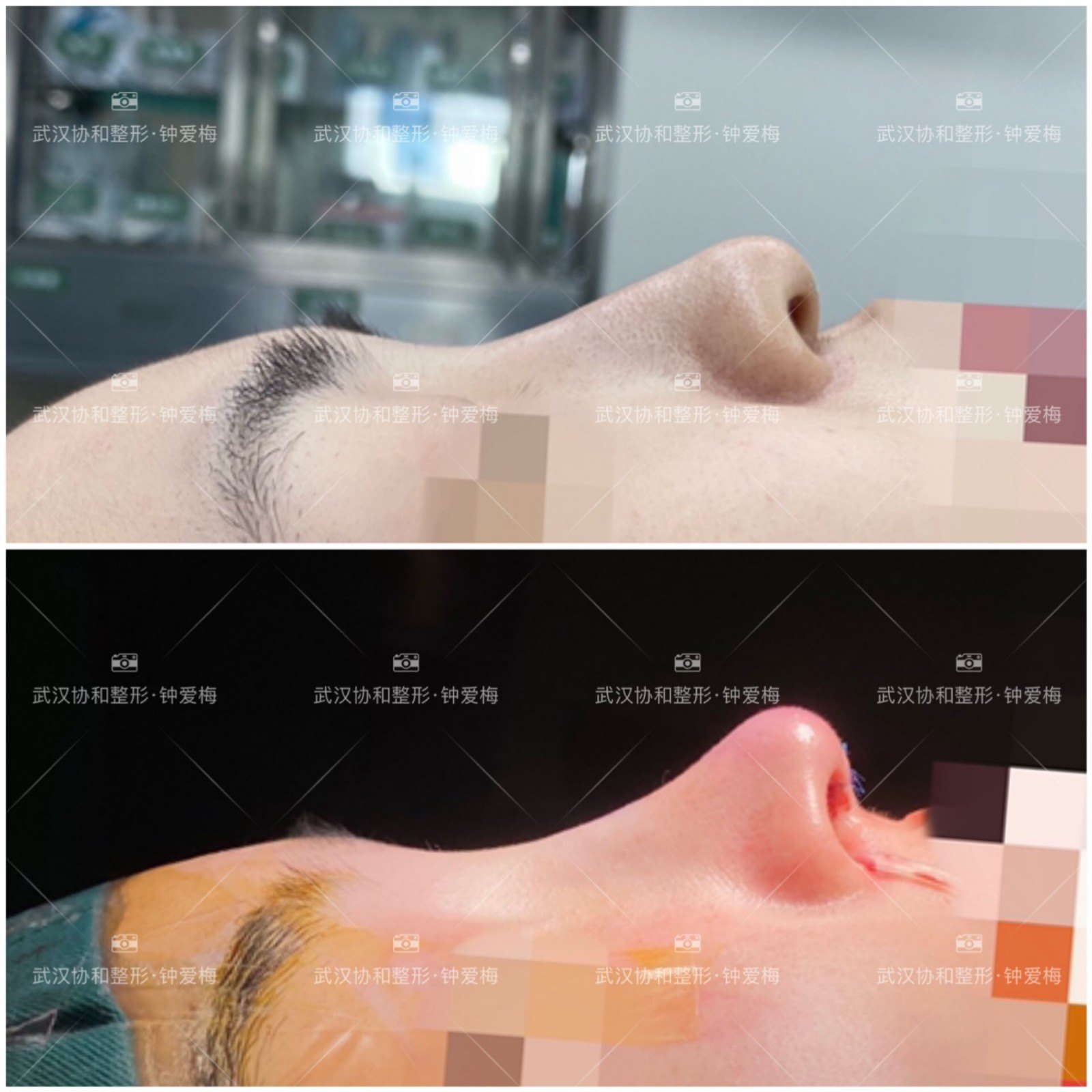 术中用筋膜包裹假体增加鼻背皮肤厚度, 鼻尖肋软骨支架抬高, 并用