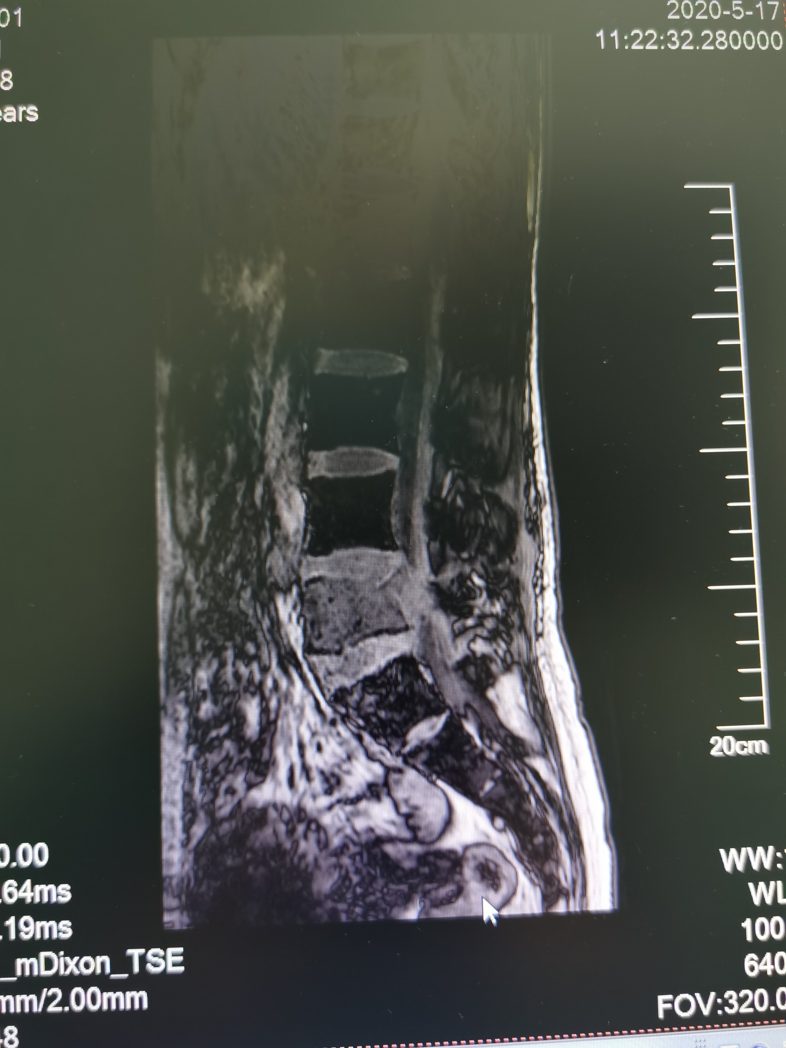 肺癌腰椎转移压迫神经手术解决痛苦,改善生存质量
