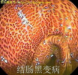 结肠黑变病(melanosis coli,mc)是以结肠黏膜黑色素沉着为特征的非