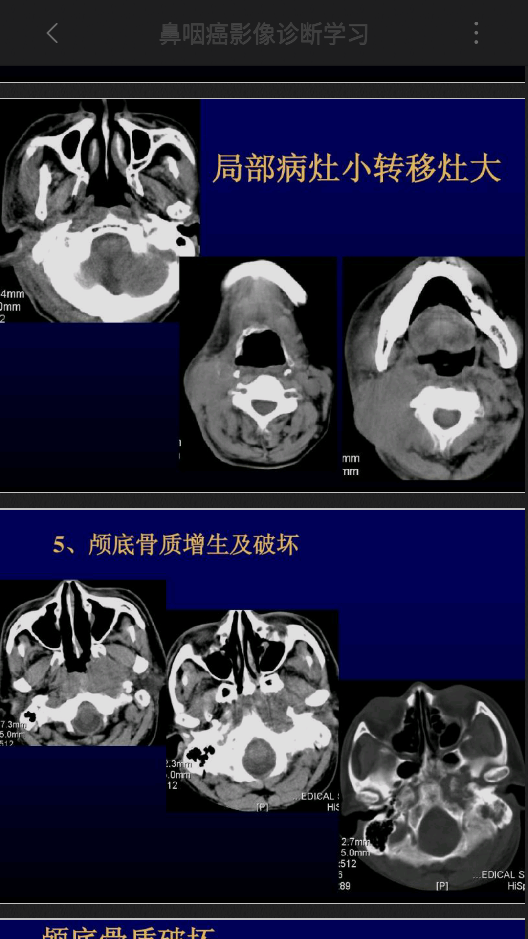 鼻咽ct.mri表现